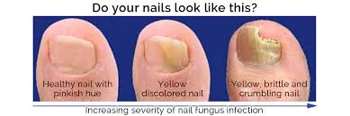 Fungal Nail Infection